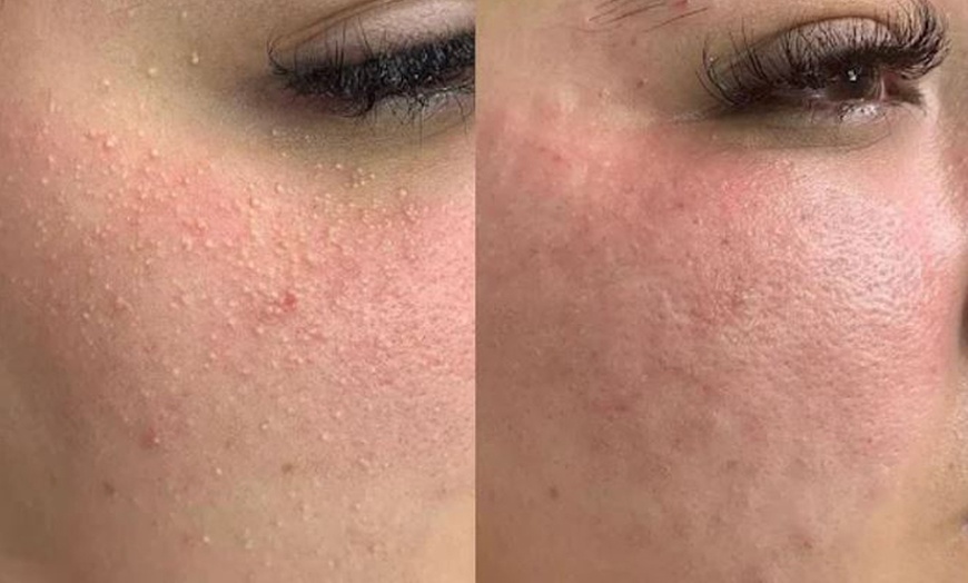 Image 4: 60-Minute 1, 2, or 3x Choice-of Facials (Acne or Microdermabrasion)