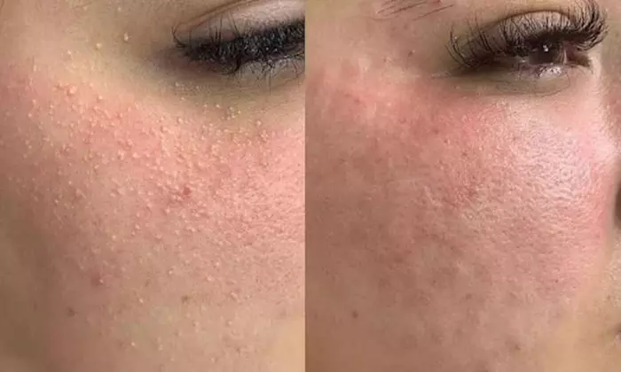 60-Minute 1, 2, or 3x Choice-of Facials (Acne or Microdermabrasion)