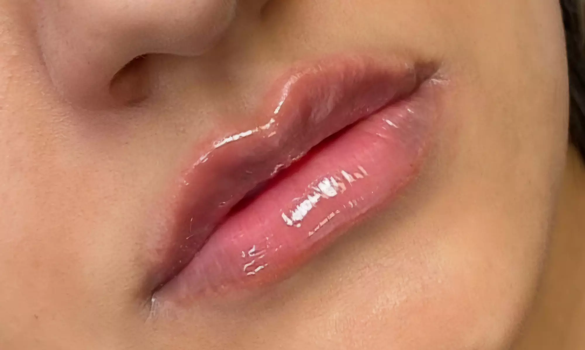 Enhance Your Features With 0.5 ml, 1ml or 2ml Fillers