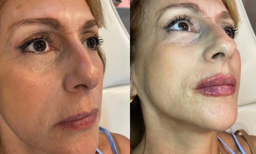 Image 4: Rejuvenate Your Look with 20 or 40 Units of Juveau