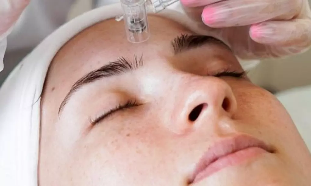 Unlock Skin Transformation with One Micro-Needling Treatment at ART iBrow Threading Salon(Up to 30% Off)  - Primary Image