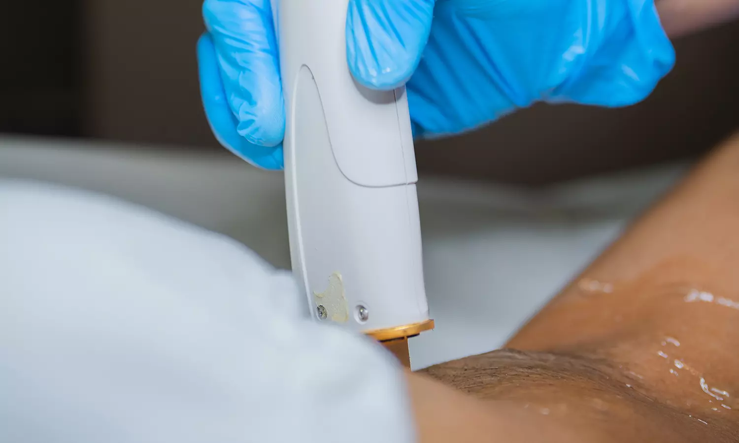 Experience Smooth Skin with Laser Hair Removal Sessions