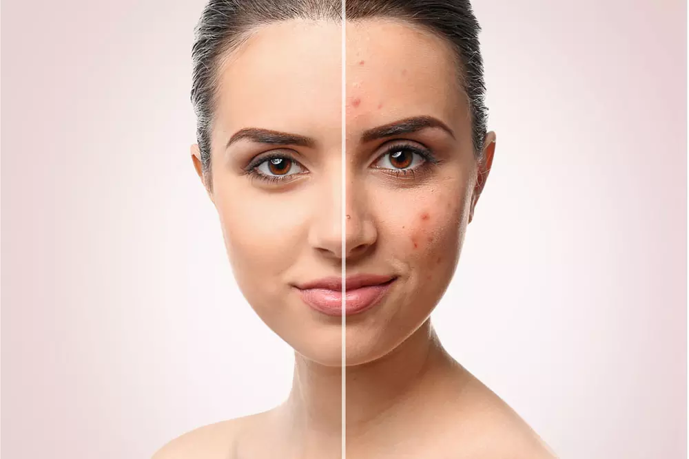 Explore Hola Beautiful's facial services, including dermaplaning and microneedling, with up to 39% off - Second Medium