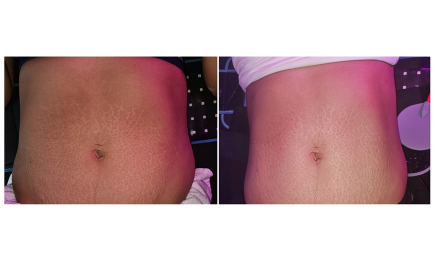 Image 3: Body Sculpting Combo Treatment