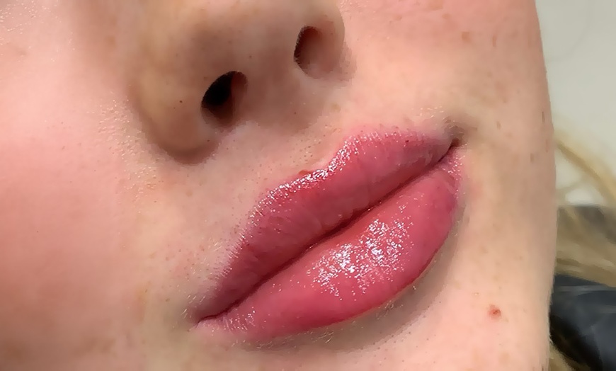 Image 5: Revitalize with 0.5ml, 1ml, or 2ml Dermal Filler Treatment on One Area