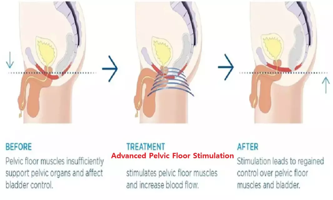 Advanced Pelvic Floor Stimulation Therapy for Incontinence Relief
