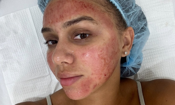 Revitalize Your Skin with One PRP Facial Sessions with Microneedling or PRP Under-Eye Injection (Up to 35% Off)