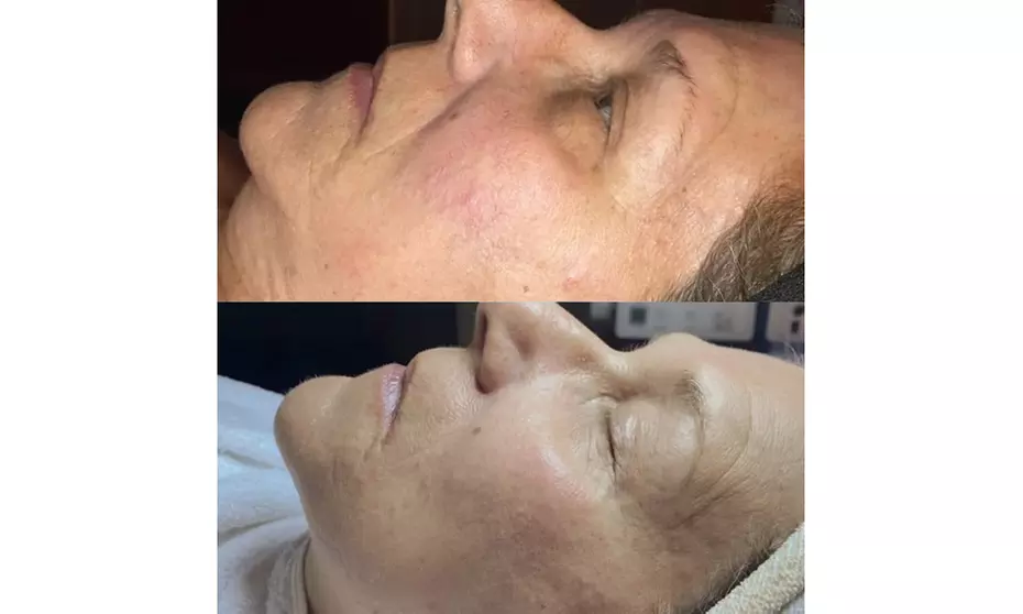 Boost Skin Firmness and Elasticity with Microcurrent Sessions