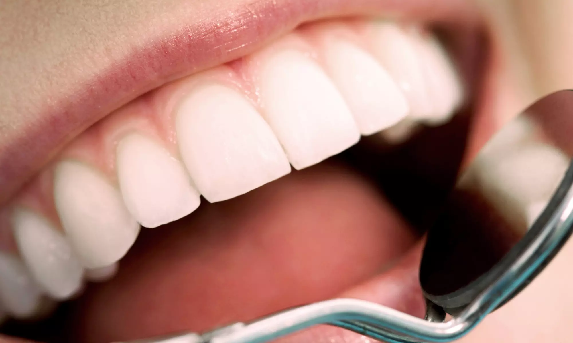Tooth Extraction or Mini-Dental Implant at Express Denture Care Off (Up to 49% Off) - Primary Image