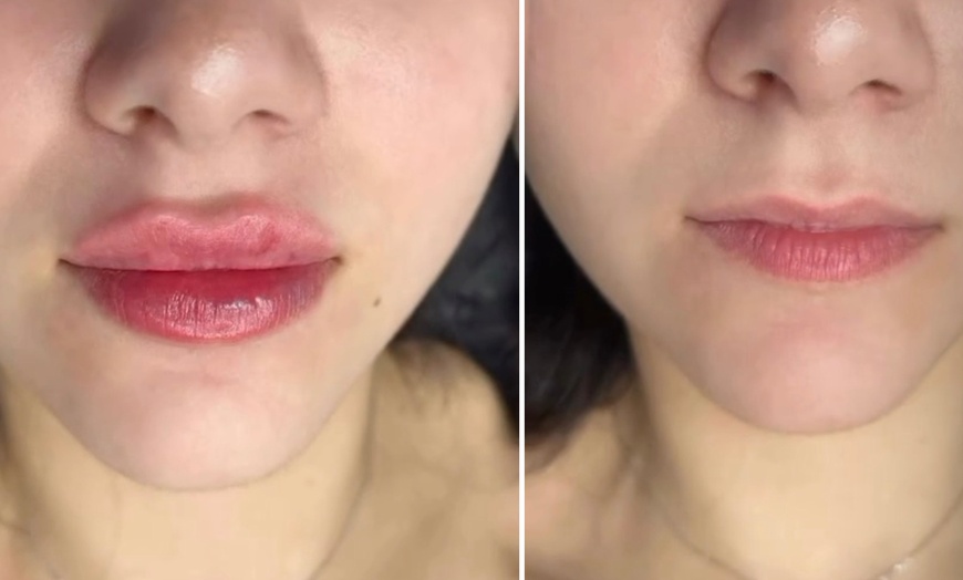 Image 7: Transform Smile: 0.5-, 1-, or 2-ml Dermal Filler or Dissolver & Refill