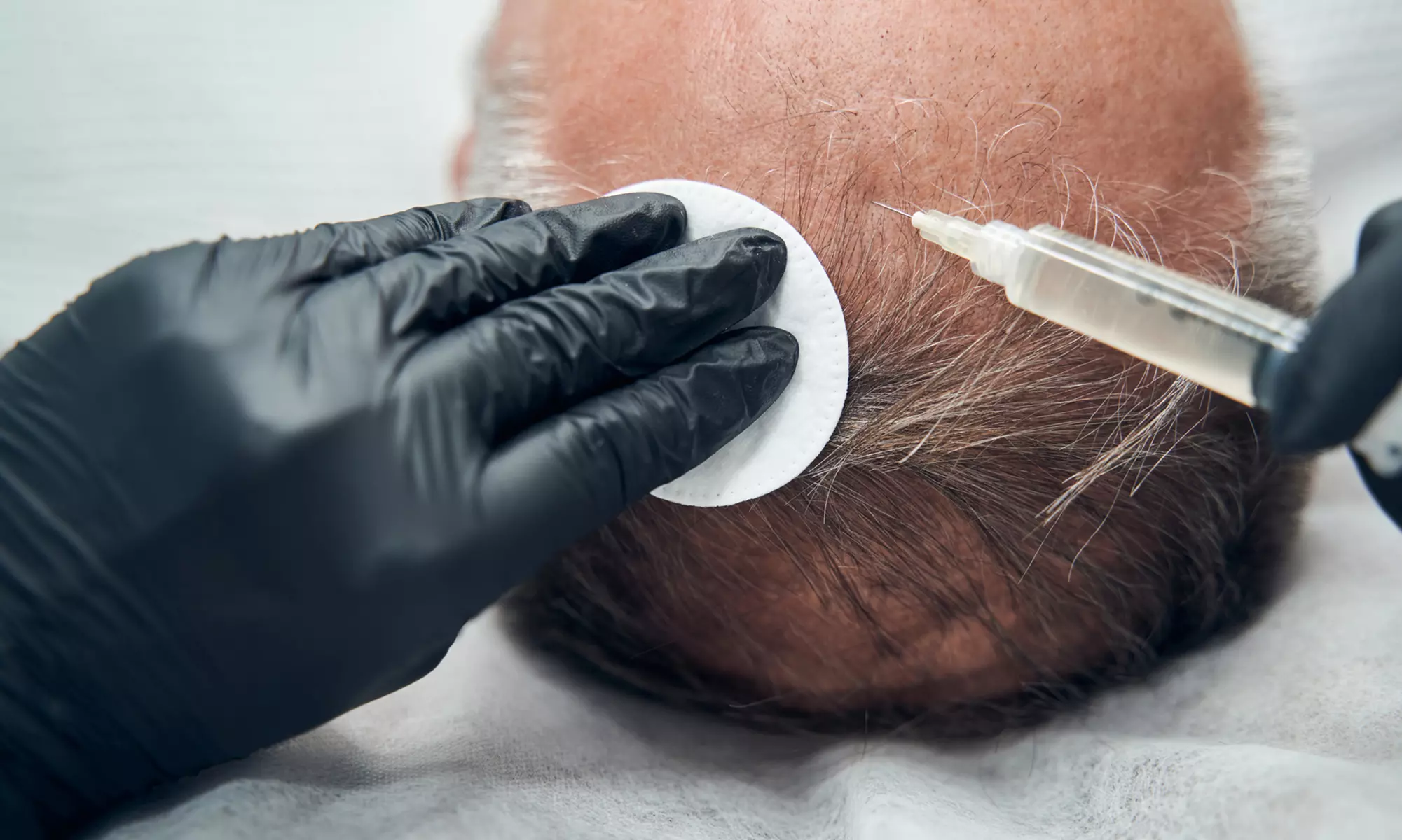Up to 55% Off on Hair Restoration - Non-Surgical at MycroAesthetics