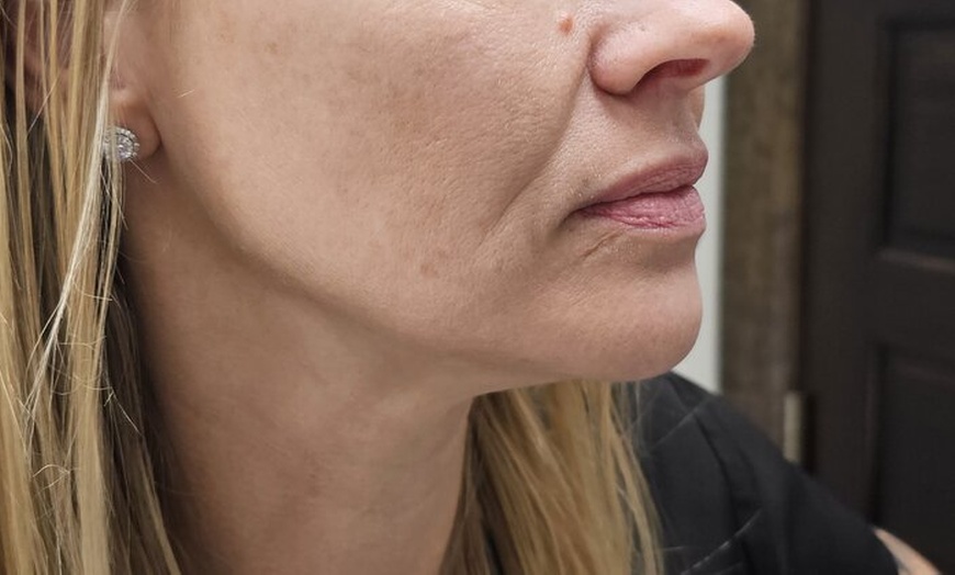 Image 7: Revitalize Your Skin with IPL Photofacial Treatments