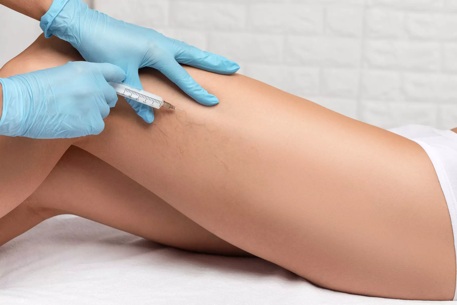 Radiant Beauty & Health offers sclerotherapy spider vein treatment with up to 50% off. Choose two or four syringes. - Primary Image