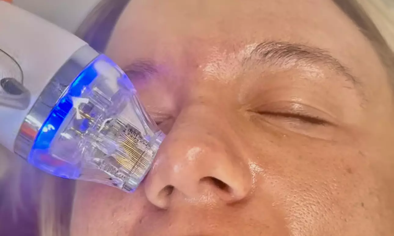 Unveil radiant skin with three Microneedling treatments and PRP face