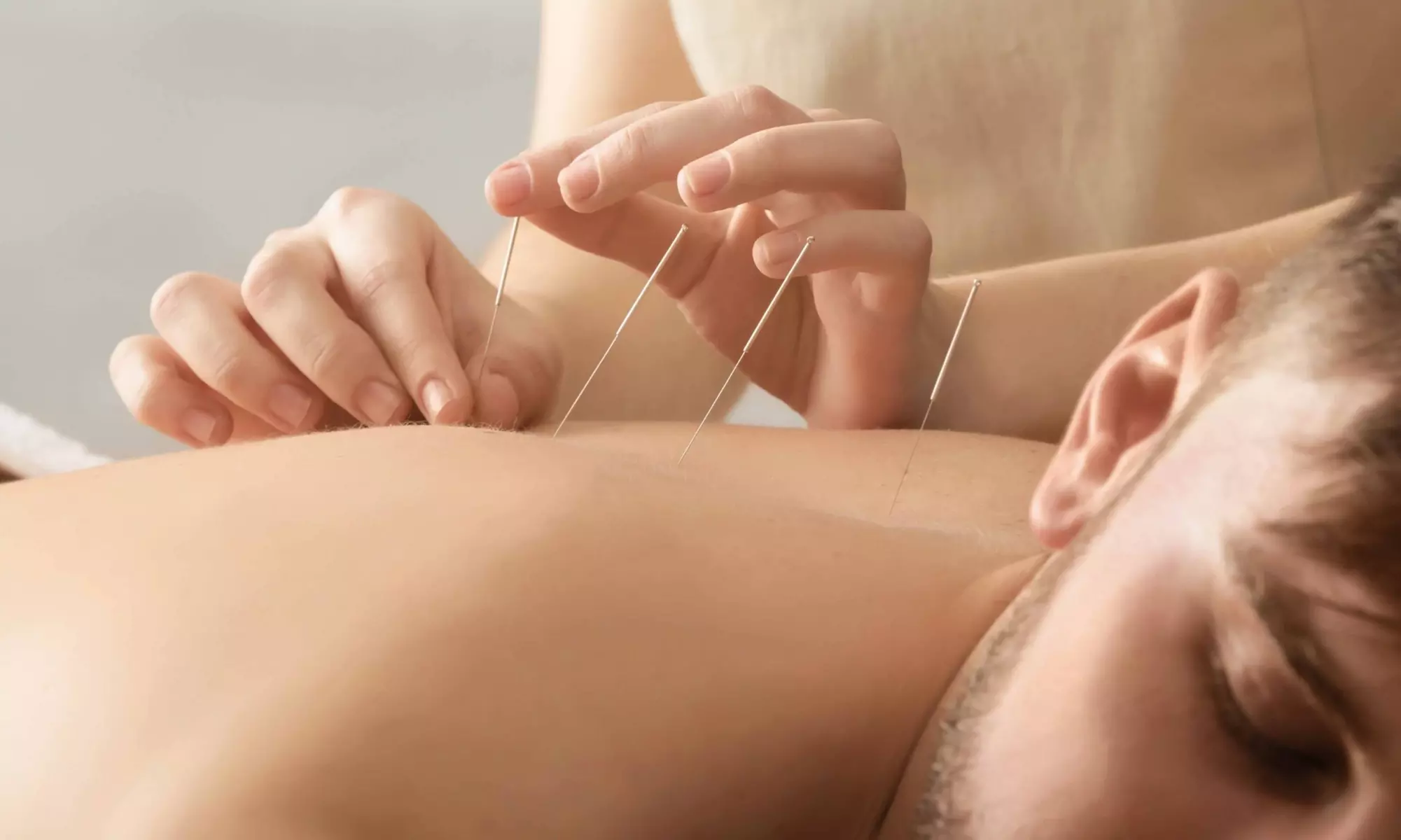 25-Minute Cupping or Dry Needling for One ($29) or Two People ($55) at Aussina Natural Health Centre (Up to $98 Value) - Primary Image