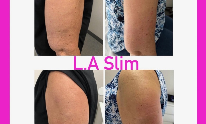 Image 2: Ultrasonic Arm Fat Reduction with Noninvasive Technology
