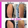 Image 2: Ultrasonic Arm Fat Reduction with Noninvasive Technology