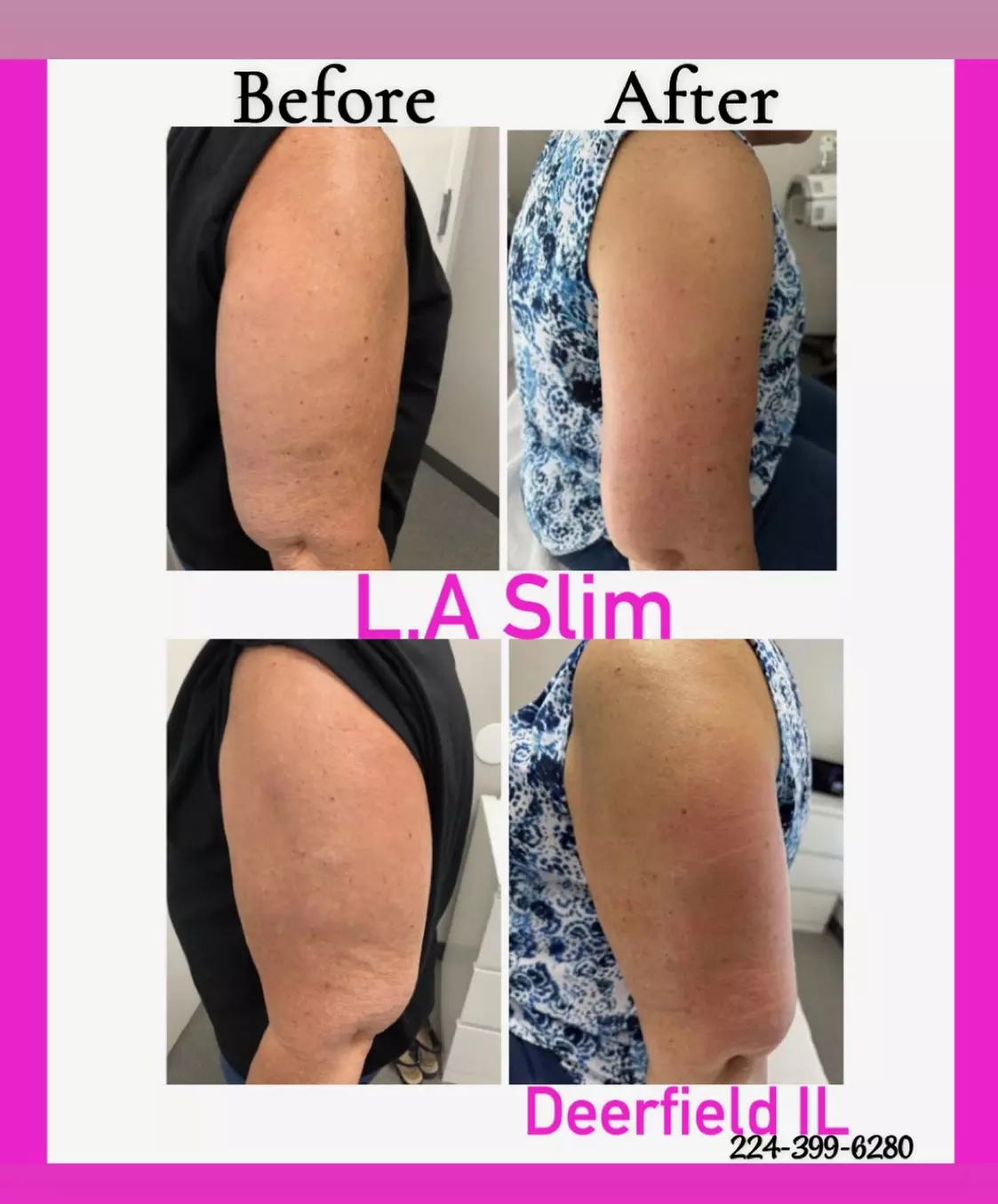 Ultrasonic Arm Fat Reduction with Noninvasive Technology