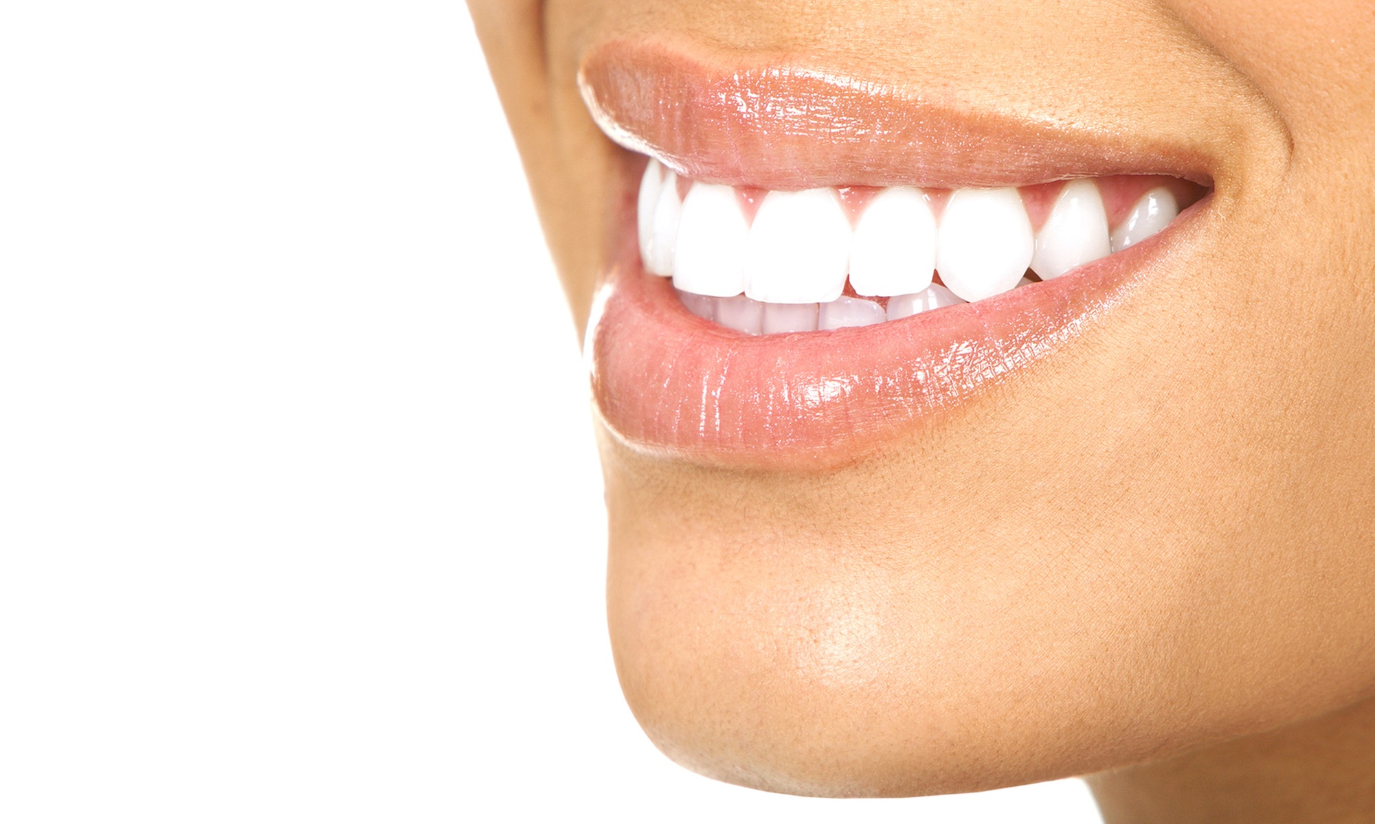 1 ou 3 séances de blanchiment dentaire, formule au choix