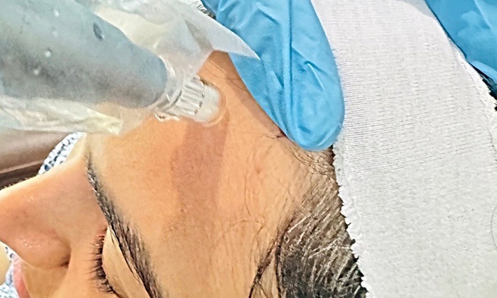 Up to 60% Off on Microneeding with PRP at Sunshine Glow MedSpa - Primary Image