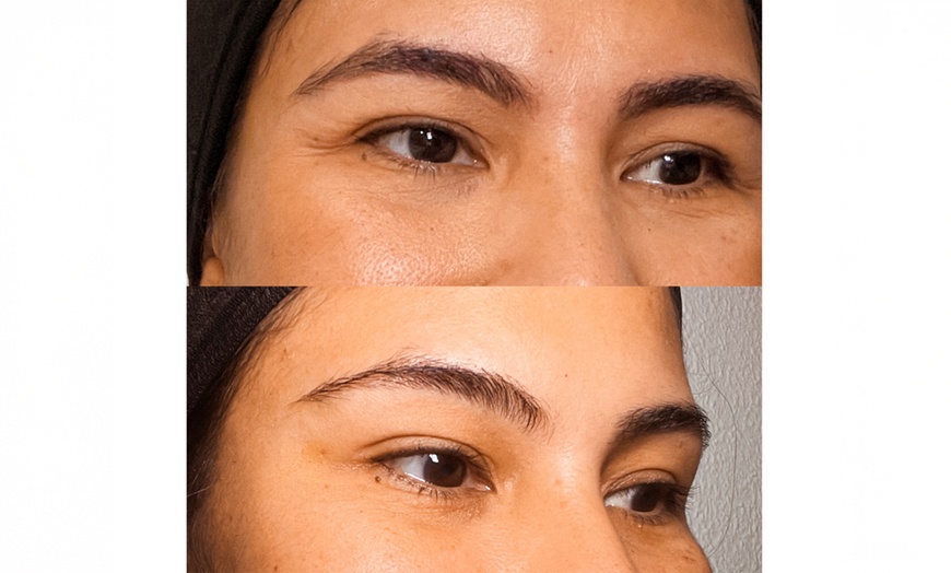 Image 4: Infiltración facial efecto lifting con opción a retoque y mesoterapia