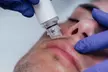 1 o 2 sesiones de tratamiento facial combinado con tecnología Indiba ONA para 1 persona: exfoliación, hidratación y más - Image 2