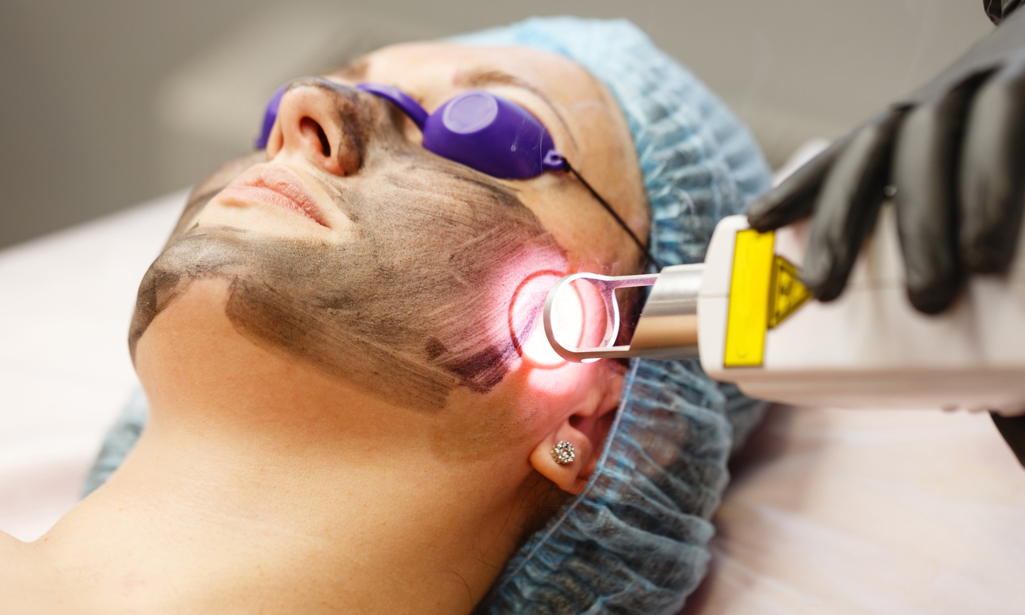 Up to 48% Off Carbon Laser Peel at NYC MedSpa
