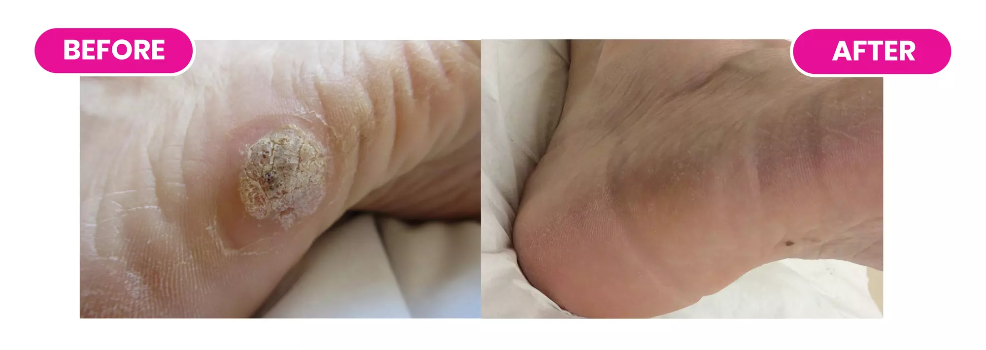 Expert Treatment of Up to 3 Warts or Verrucas (Up to 84%)