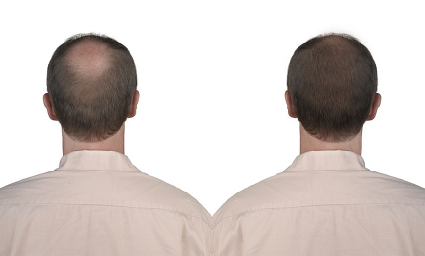 Image 1: Up to 50% Off on Hair Restoration - Other at Cosmetic Doctors