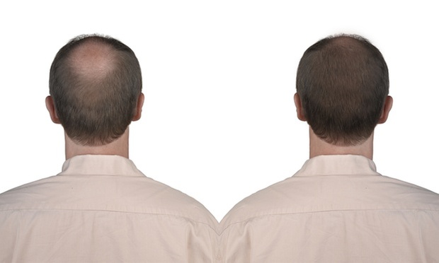 PRP Hair Restoration at BodyBrite Markham