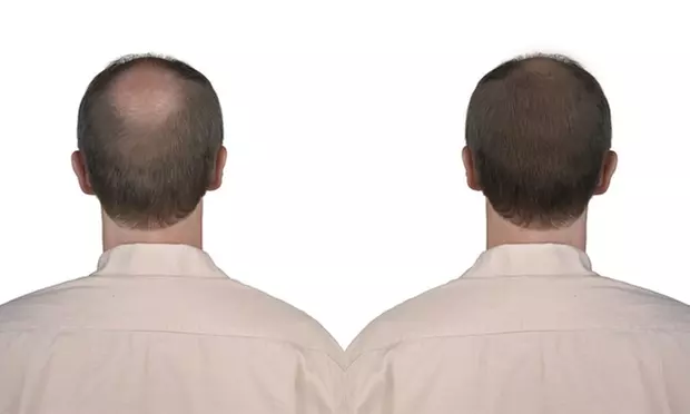 PRP Hair Restoration at BodyBrite Markham