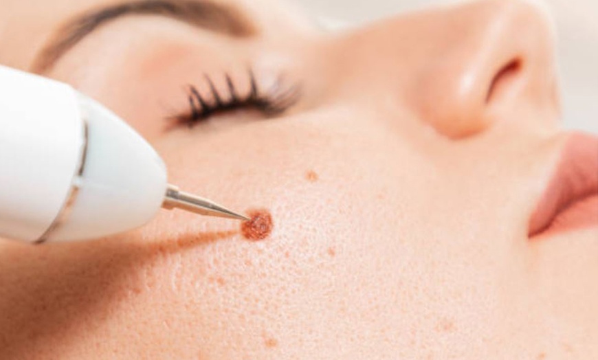 Image 6: Eliminación de varices o verrugas con tecnología avanzada 