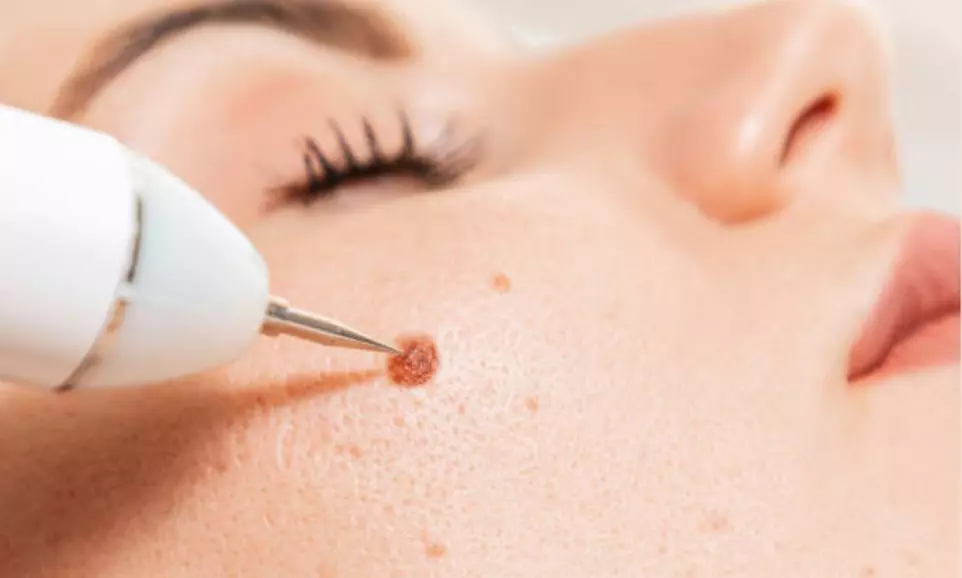 Eliminación de varices o verrugas con tecnología avanzada
