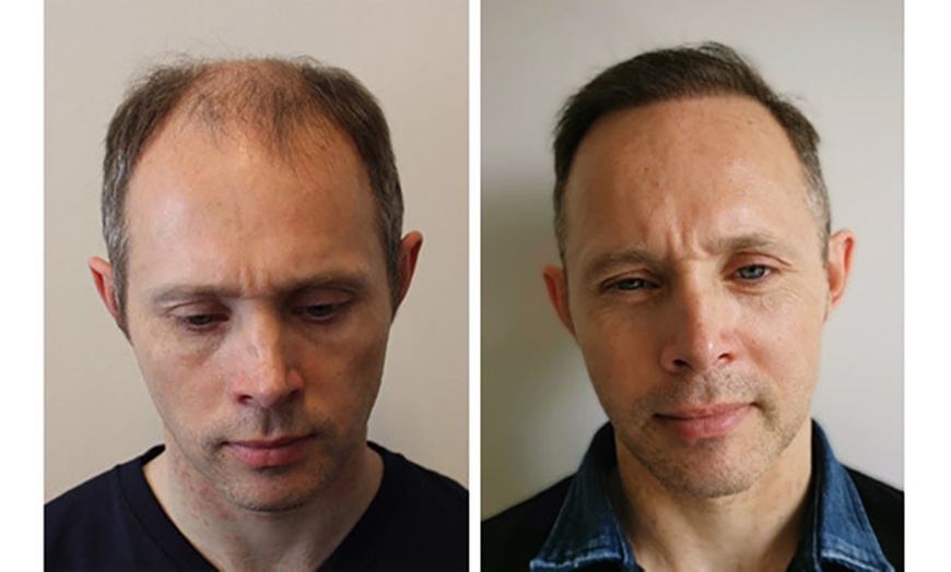 Image 4: Transform Your Look with 1000, 2000, or 3000 Graft Transplant