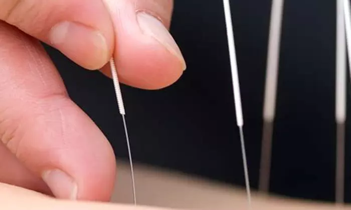 1 o 3 sesiones de acupuntura personalizada con diagnóstico previo