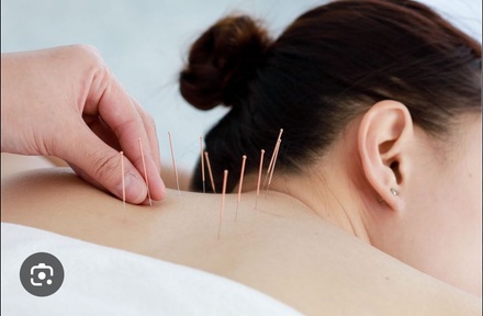 One Acupuncture Session - Accurate Chiropractic Care