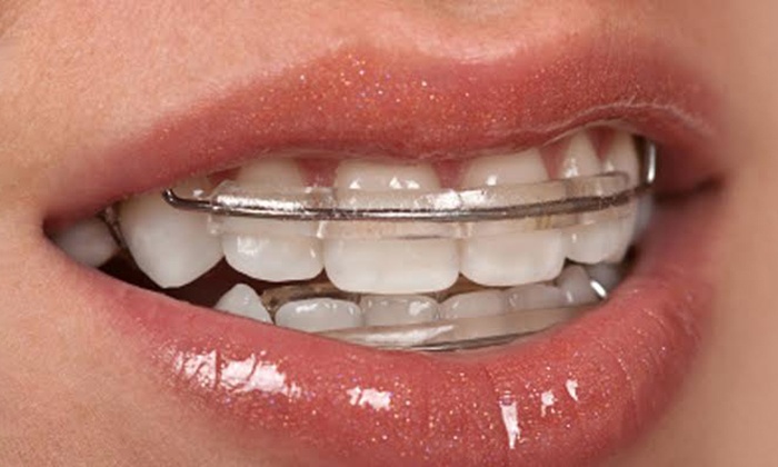 Smile Aligner - West 1 Dental Clinic | Groupon