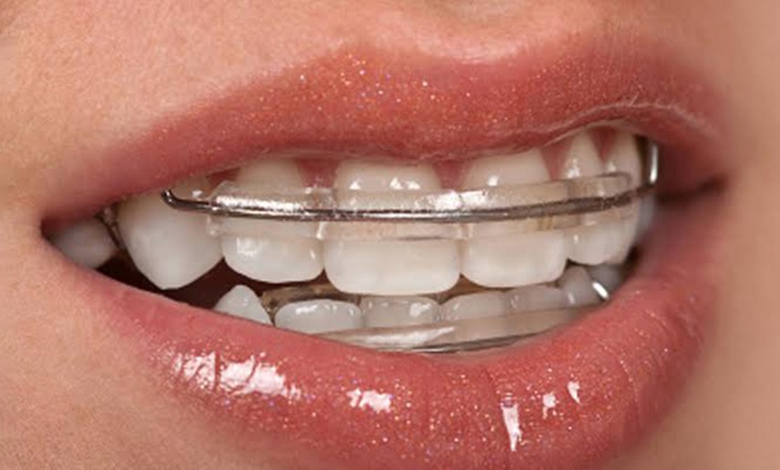 Image 1: Smile Aligner