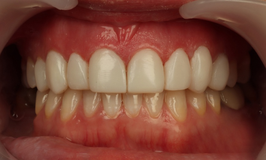 Image 4: Composite Bonding with Whitening at Poynton Dental Practice