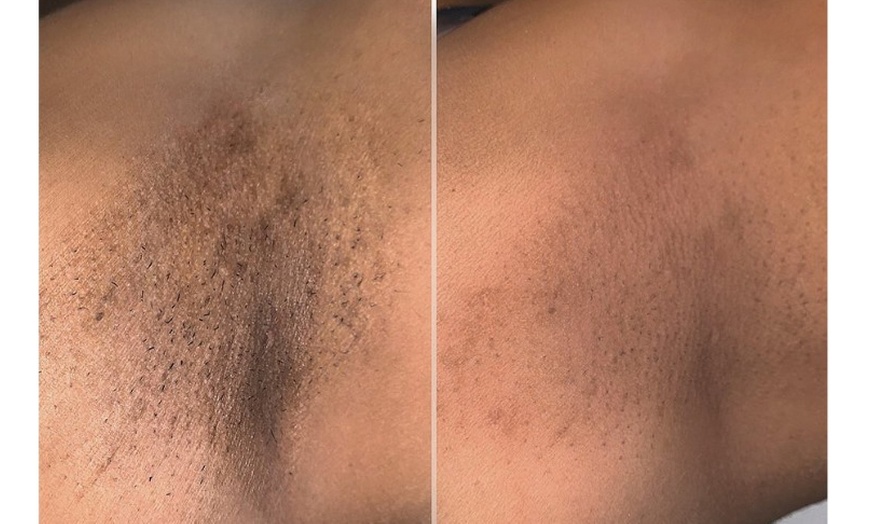 Image 4: 6 Sessions of Aerolase® Neo Elite Laser Hair Removal 
