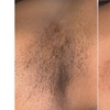 Image 4: 6 Sessions of Aerolase® Neo Elite Laser Hair Removal 