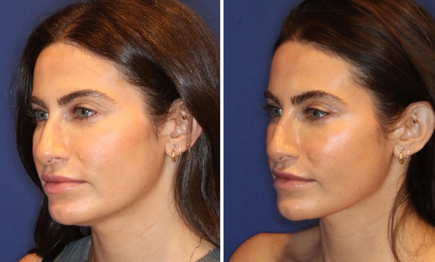 Image 2: 40 Units Jeuveau & Nefertiti Lift for Frowns, Jawline & Neck