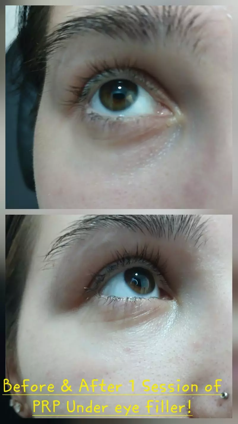 Get 1 or 2 Under Eye PRP with Platelet-Rich Plasma Sess Treatment