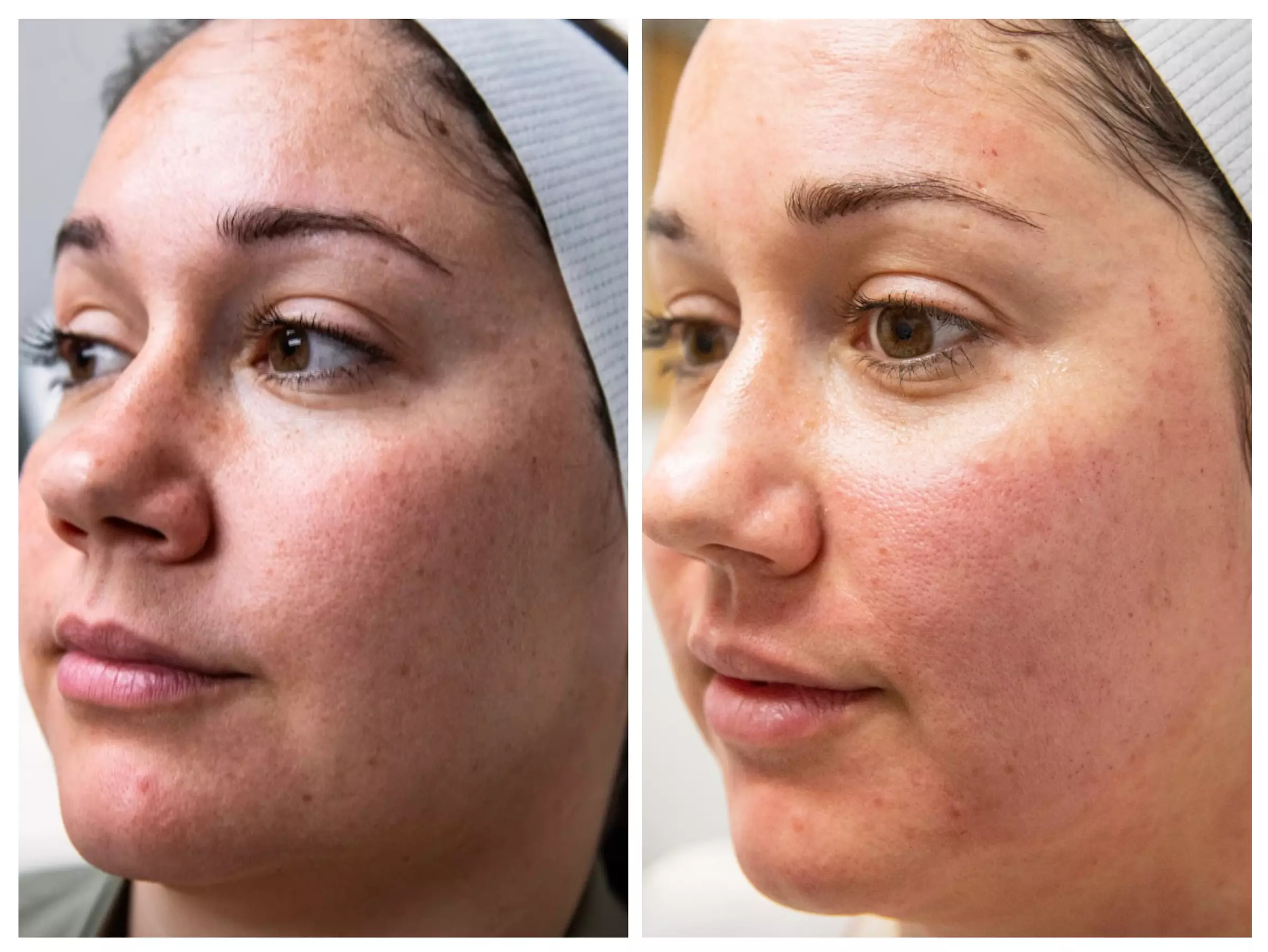Up to 33% Off on Injection - Plasma at European Med/Beauty Family Clinic