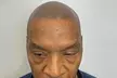 2 or 4 Hour Scalp Micropigmentation for Hairline, Crown or Full Scalp Restoration at Authentic SMP(Up to 33%Off) - Second Medium