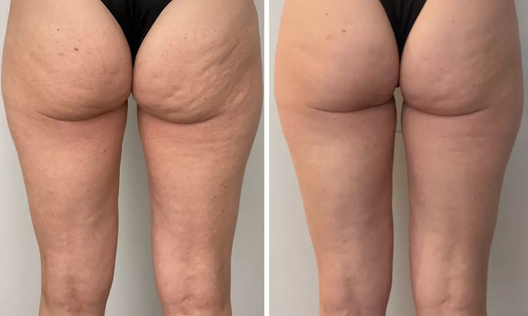 1, or 2 Muscle Building Body Sculpting Session for Abdomen or Buttocks