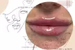 Perfect Your Pout with Dermal Filler - 0.5ml or 1ml  (Up To 60% Off) - Image 6