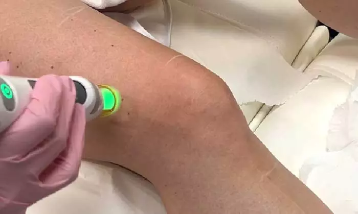 Six Laser Hair Removal Sessions of Your Chosen Area by Experts at Get Glowing Medspa (Up to 50% Off) - Second Medium