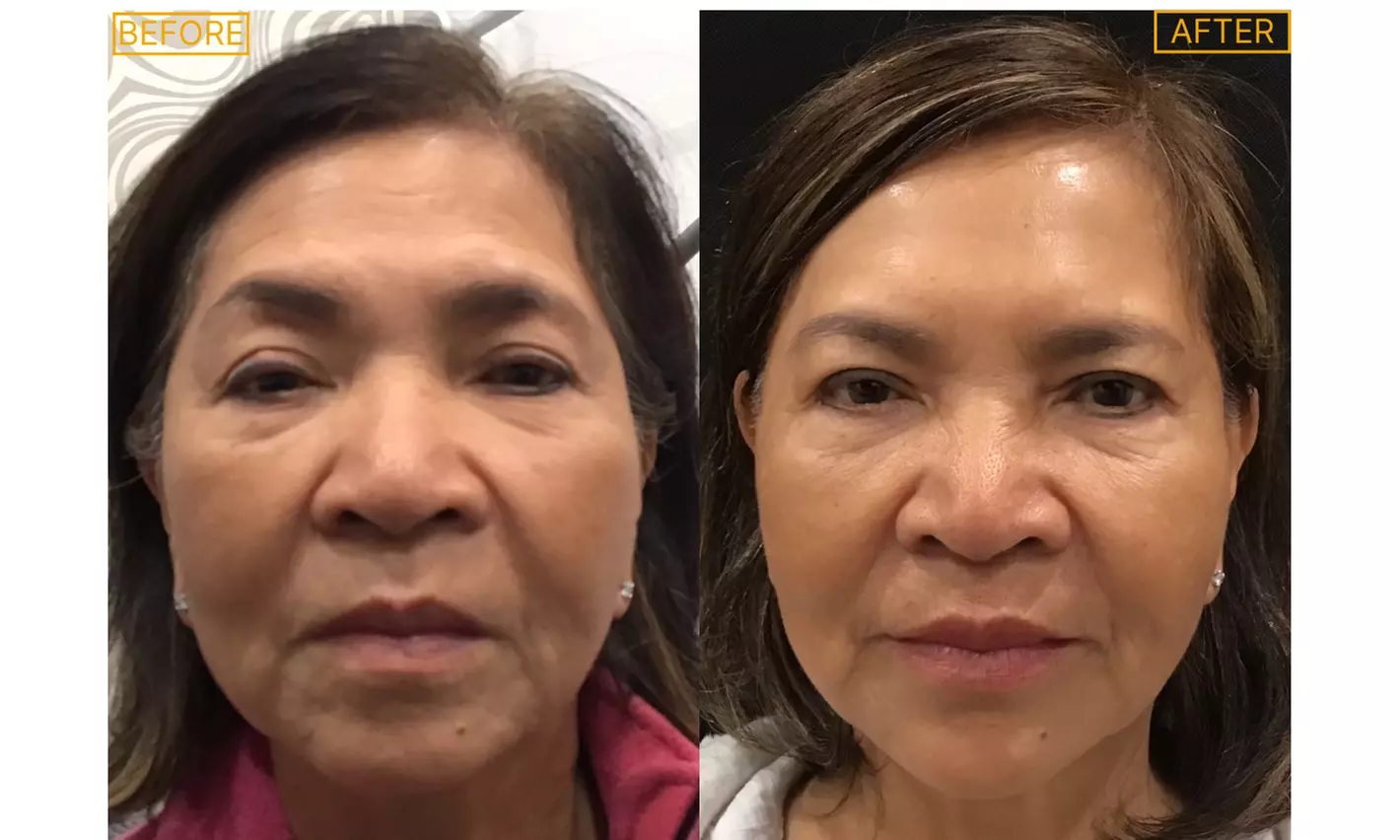 Revitalize with Juvederm Ultra or Voluma XC Syringe Options
