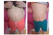One, Two, or Three Fat Freezing Treatments with Complimentary Meal Plan at Liposuction Belfast (Up to 67% Off) - Image 4